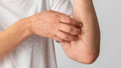 Спалах кору в Індонезії: як релігія перешкоджає щепленням для дітей - фото