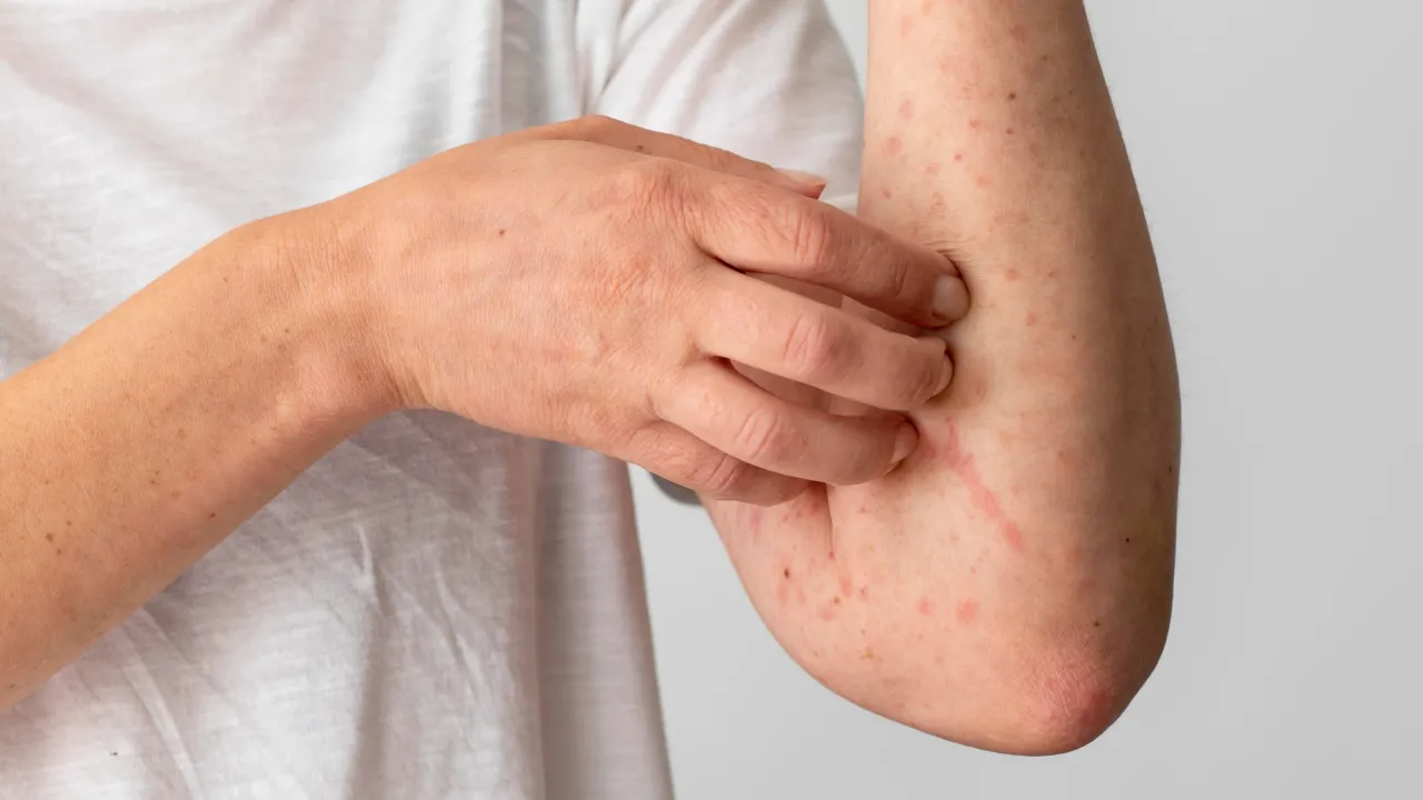 Спалах кору в Індонезії: як релігія перешкоджає щепленням для дітей 